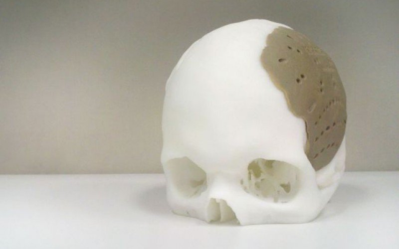 Protesi 3d nel cranio: chirurgia hi-tech per tumore osseo a Chieti